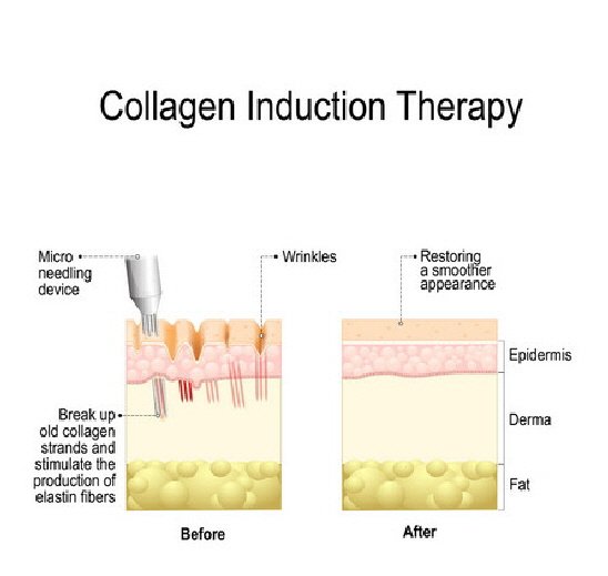 Collagen Treatment at Maples Bridgend